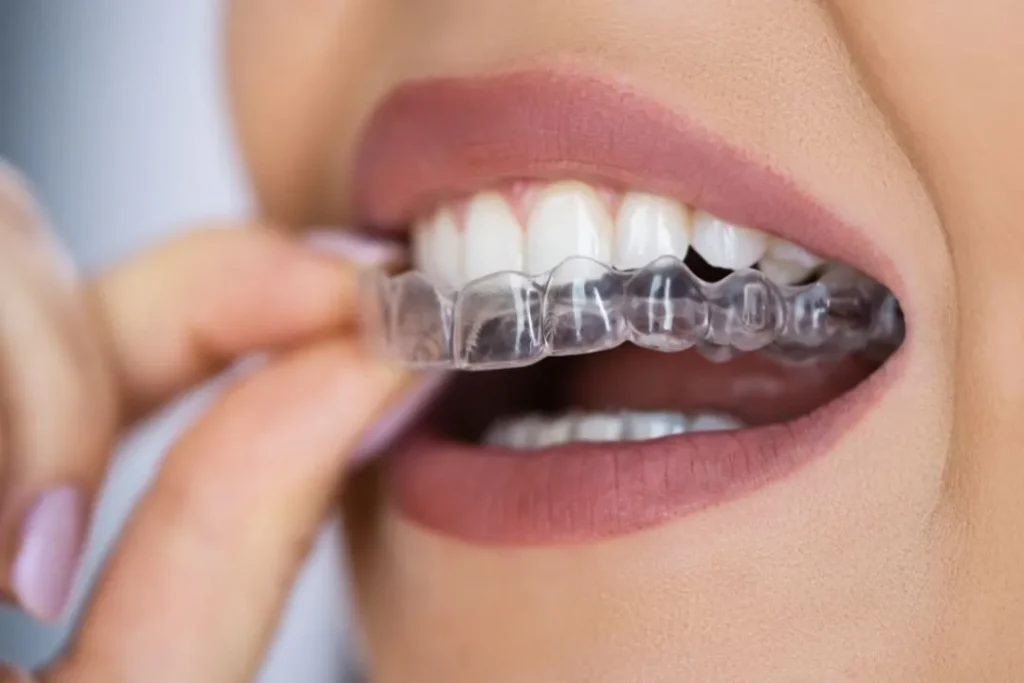 Invisible Aligners in Chinchwad