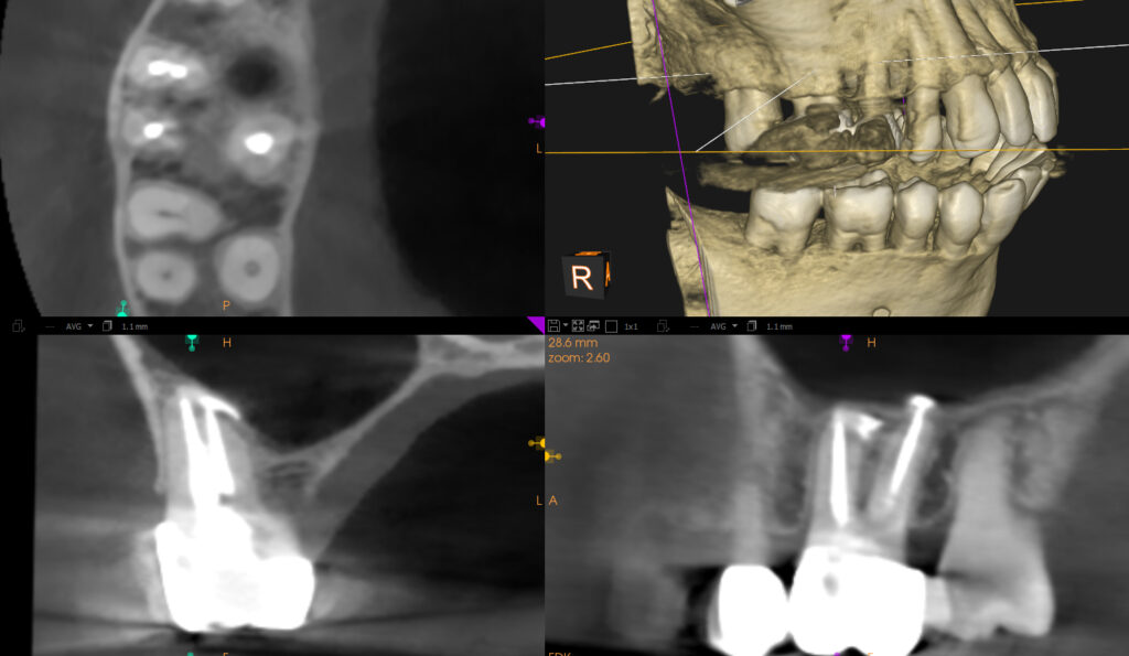 Are Dental X-Rays Safe