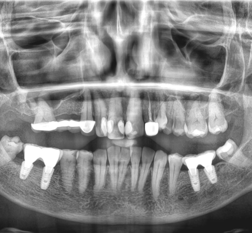 Implants in Chinchwad