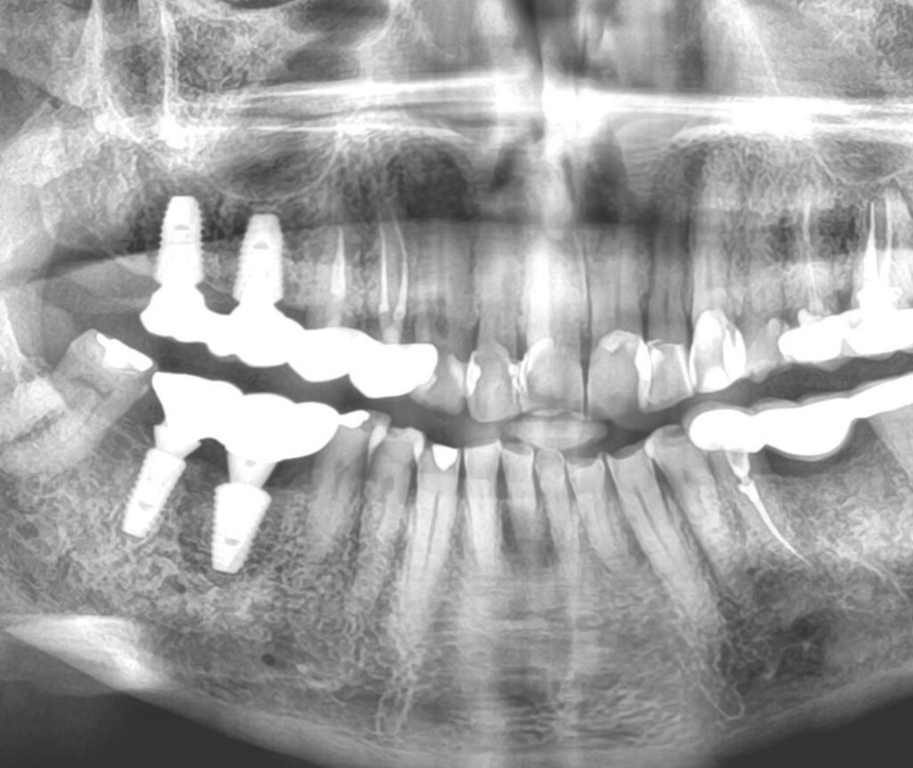 Dental Implants in Chinchwad