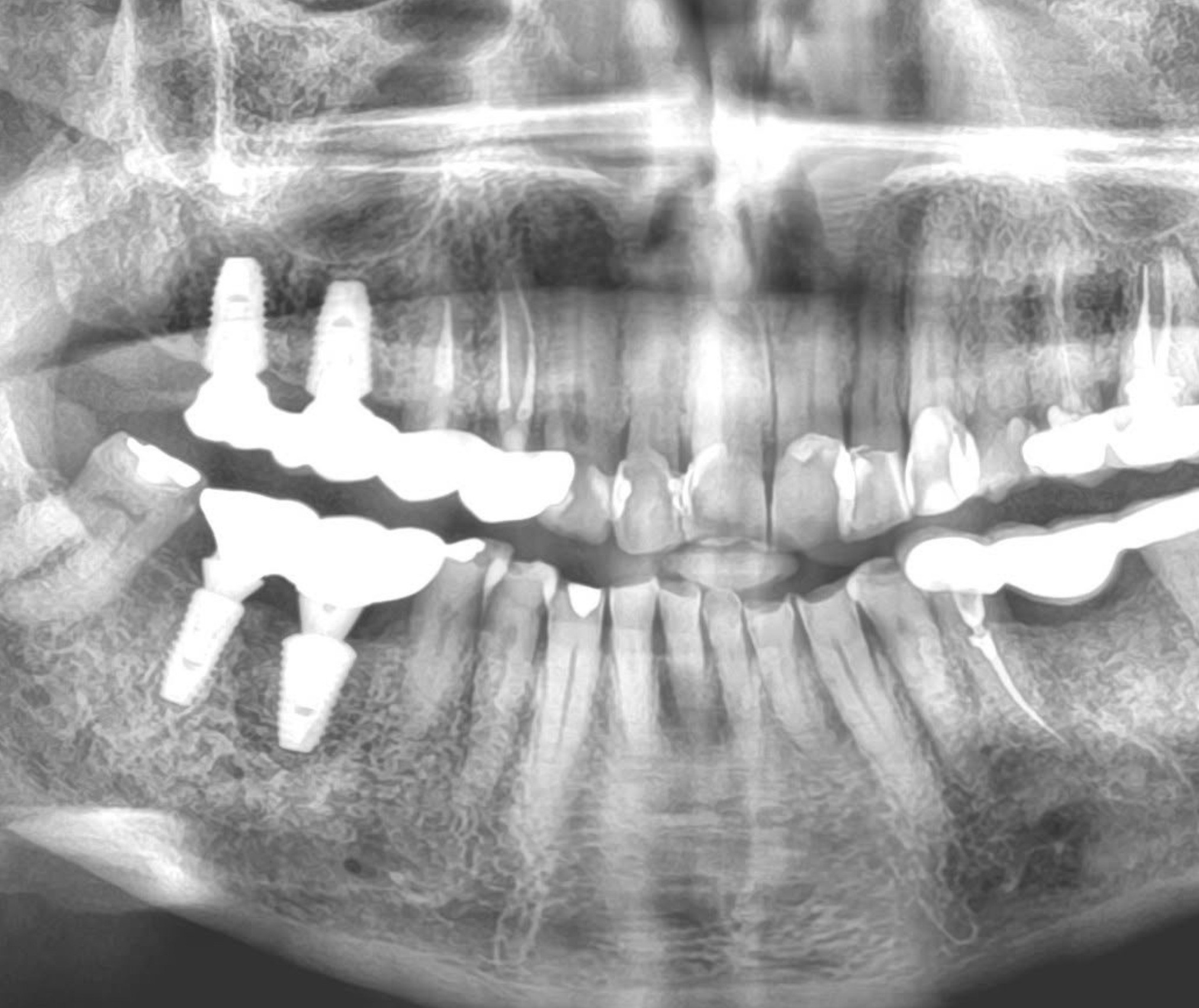 Dental Implants in Chinchwad