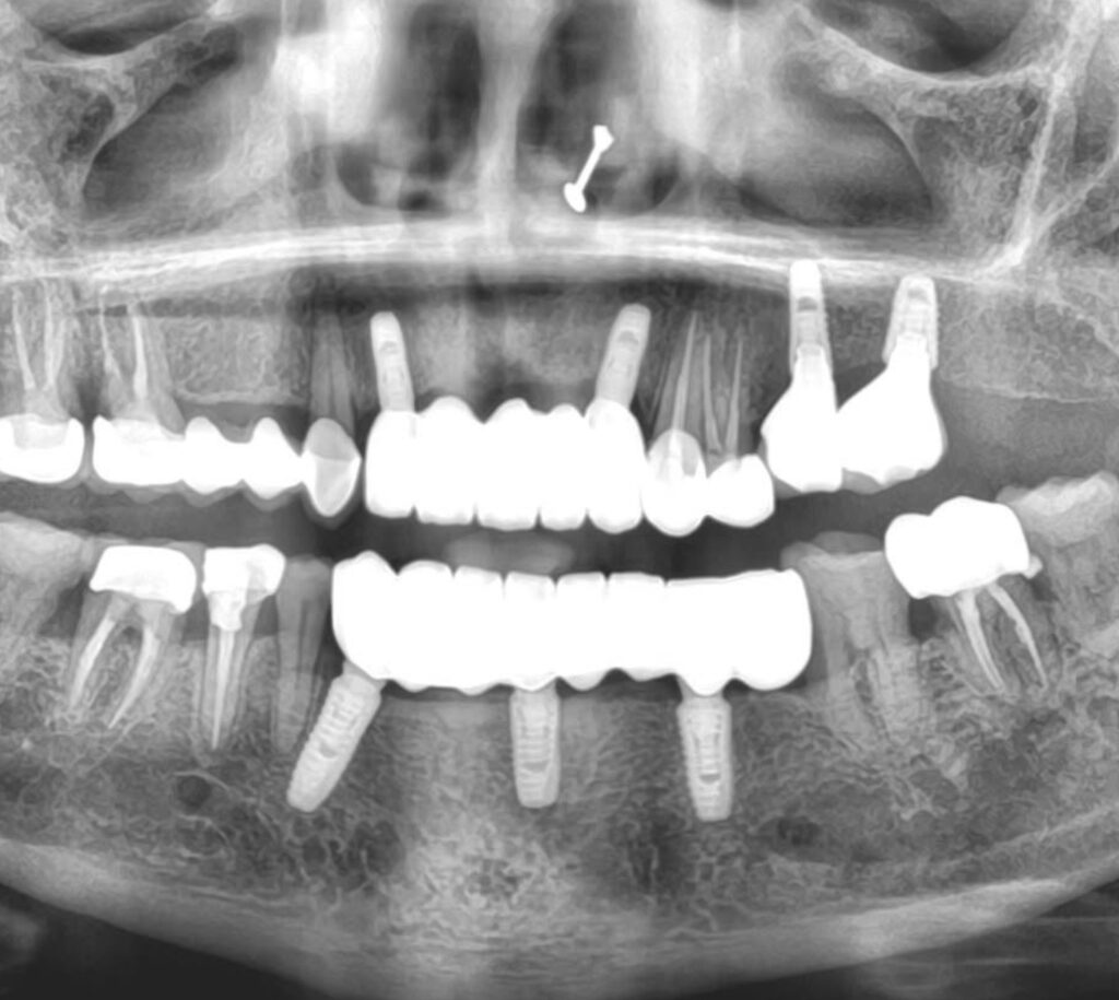 Best dental implants in Chinchwad