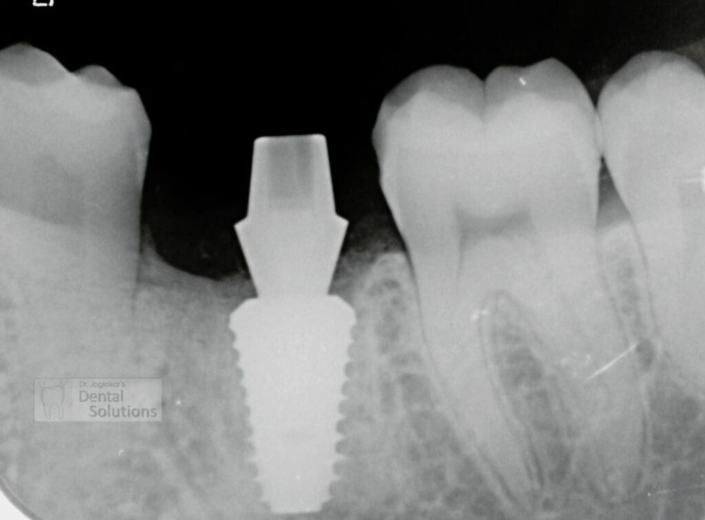 Dental Implants in Chinchwad