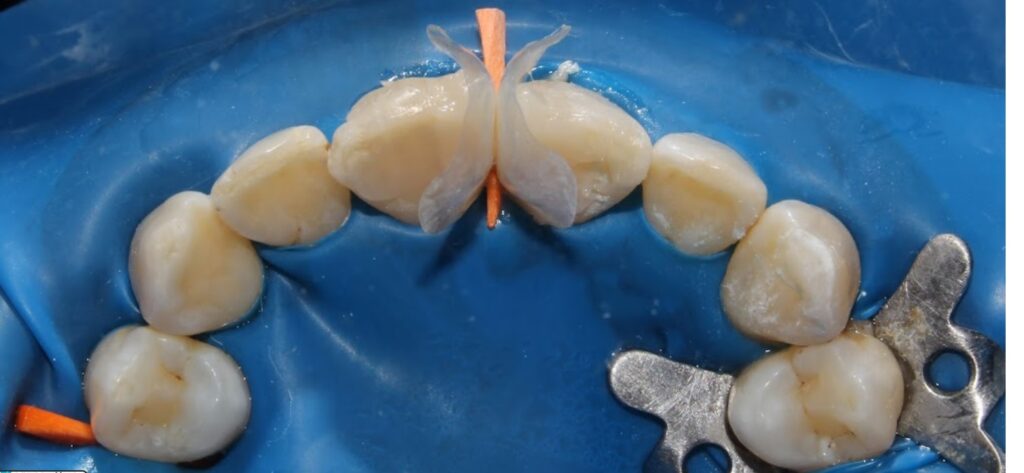 Advanced Root Canal Treatment in Chinchwad