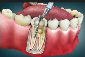 Painless Root Canal Treatment