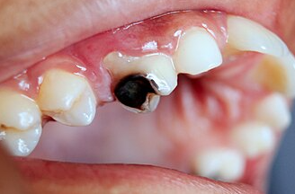 Prevent Cavities