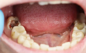 How to Effortlessly Prevent Cavities (And What to Do If You Already Have One)