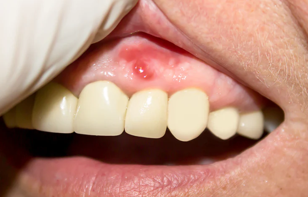 Gum Disease