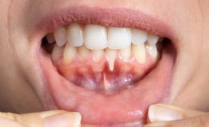 Gum Disease: The Silent Problem Most People Ignore
