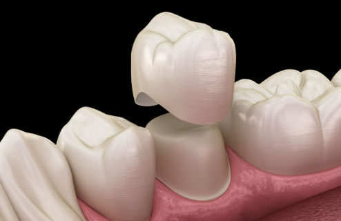 Crowns vs Fillings