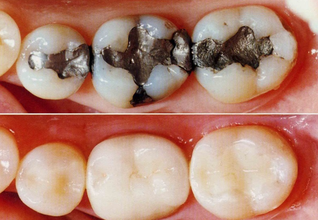 Crowns vs Fillings
