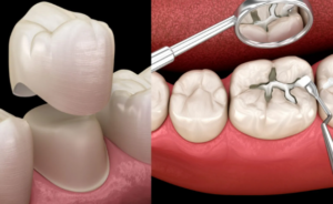 Crowns vs Fillings: The Proven Way to Know Which One You Need