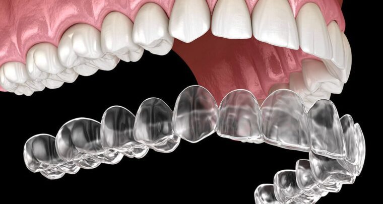 Best Invisible Aligners in Chinchwad