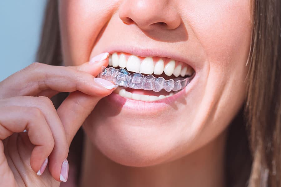 Best Invisible Aligners in Chinchwad