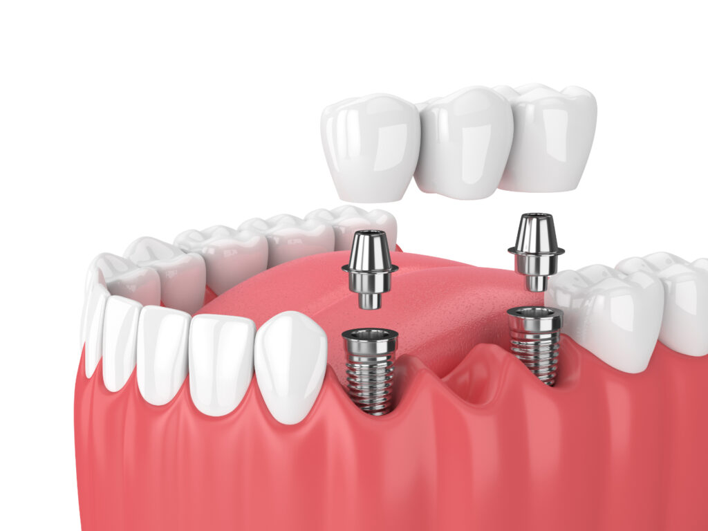 Best dental implants in Chinchwad