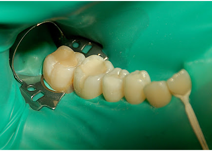 Rubber Dam in Dental Treatment