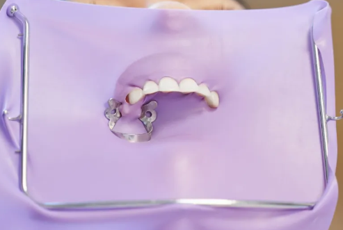  Rubber Dam in Dental Treatment