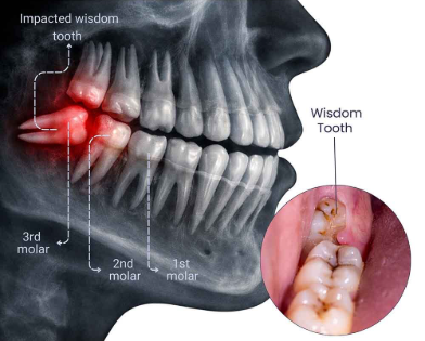 Wisdom Teeth Removal