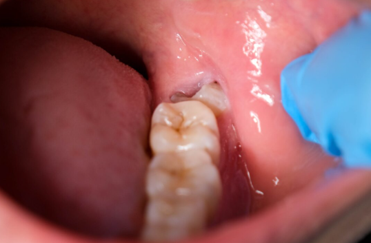 Wisdom Teeth Removal