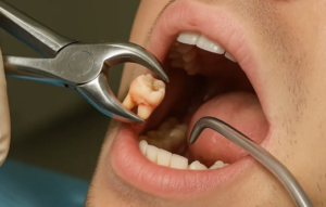 Wisdom Teeth Removal: The Essential Warning Signs