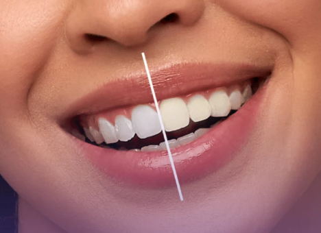 Teeth Whitening