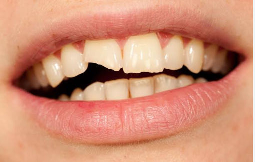 Cracked Tooth Syndrome