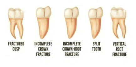 Cracked Tooth Syndrome