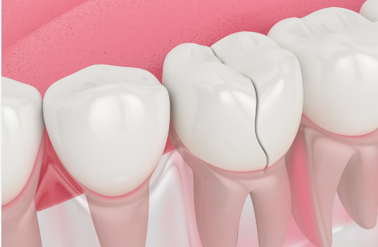 Cracked Tooth Syndrome