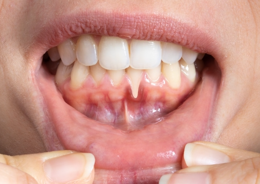 Receding Gums