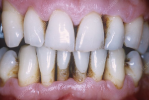 7 Warning Signs of Receding Gums You Shouldn’t Ignore