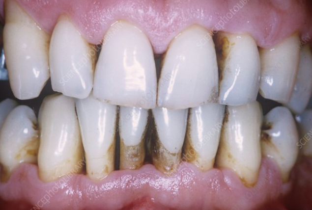 Receding Gums