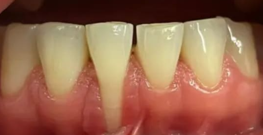 Receding Gums