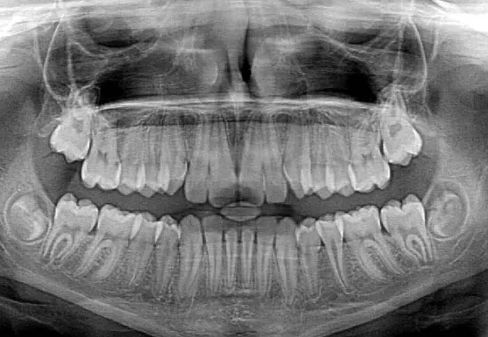 Are Dental X-Rays Safe