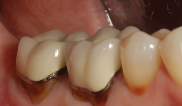 Cavity Under Filling