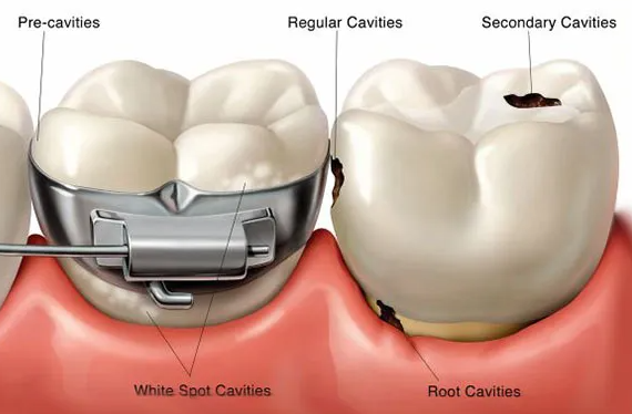 Cavity Under Filling