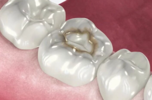 Cavity Under Filling: A Hidden Danger, Safely Preventable