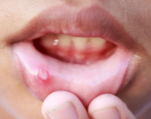 Mouth Ulcers