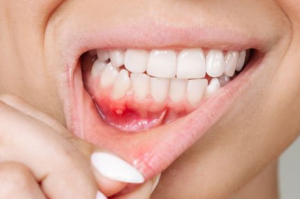 Mouth Ulcers: The Real Reasons They Keep Coming Back