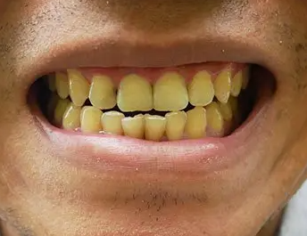 Teeth Look Yellow