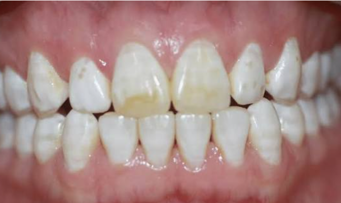 Teeth Look Yellow
