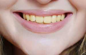 9 Real Reasons Your Teeth Look Yellow (Not Poor Hygiene)
