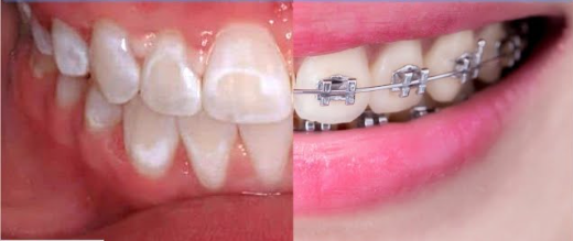 Whitening Teeth With Braces