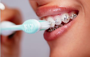 Whitening Teeth With Braces: Risky Truth vs Safe Timing