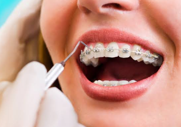 Braces as an Adult