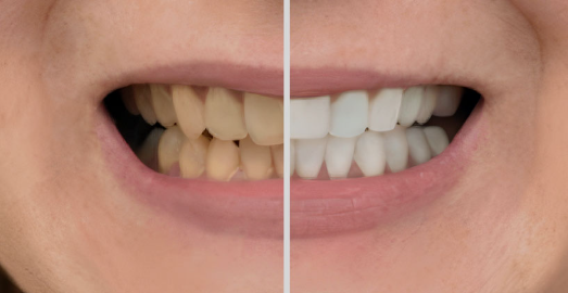 Smile Makeover