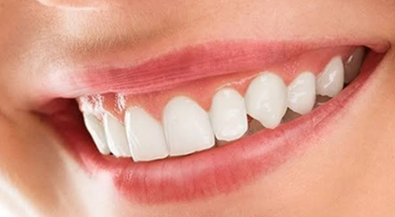 Smile Makeover