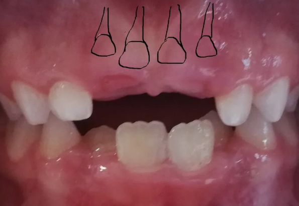 Delayed Teeth in Children