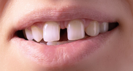 Gap Between Front Teeth