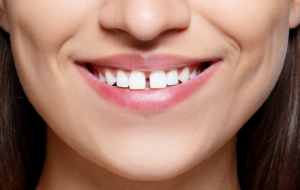 5 Truths About a Gap Between Front Teeth: Safe and Reliable Treatment