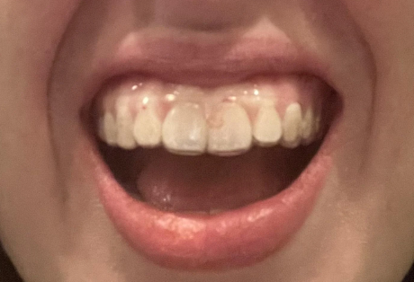 Retainer Too Tight